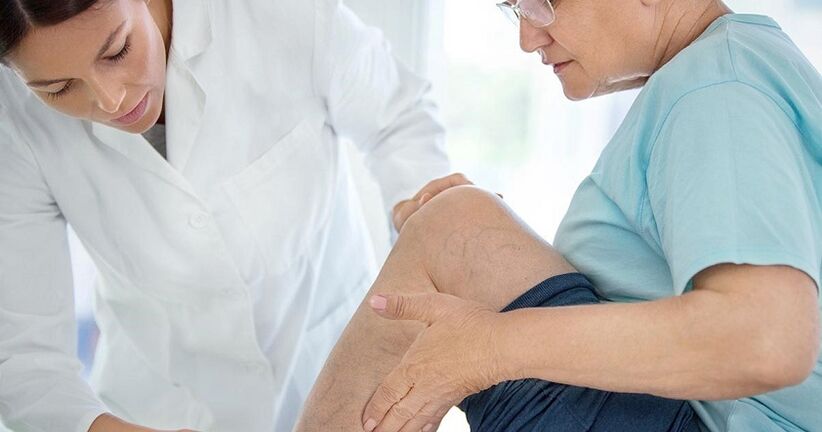 Varicolele sunt observate la fiecare a doua persoană