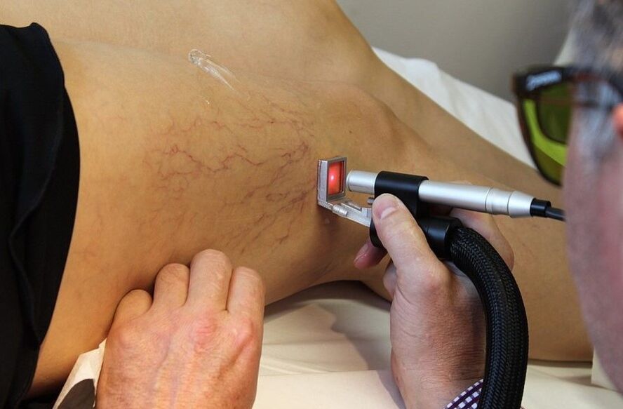 Radiații laser