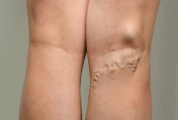 Diagnosticul venelor varicoase la gravide