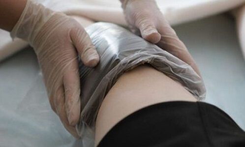 tratarea venelor varicoase cu comprese