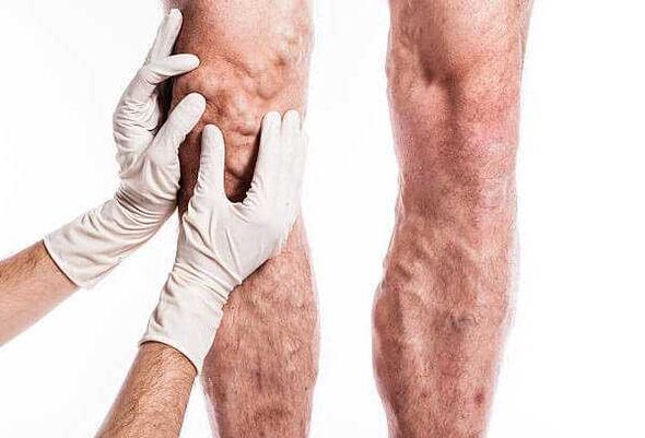 Palparea venelor varicoase pe picioare