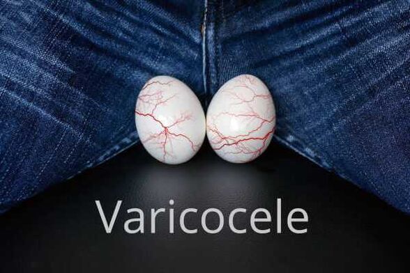 Varicocel - dilatarea venelor cordonului spermatic